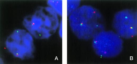 Fig. 1. (A) FISH analysis of two nuclei from patient no. 1 with cosmids 179A6 (detected with rhodamine) and 148B6 (detected with FITC), which hybridize to ETV6 exons 1 and 8, respectively. Colocalized signals indicate the normal ETV6 allele, while separate red and green signals indicate a break within ETV6. (B) Three nuclei from patient no. 1 hybridized with cosmids 179A6 (detected with rhodamine) and ICRFc108G2043QD2 (CDX2 exon 1 plus upstream sequence, detected with FITC). Colocalization of these cosmids indicates a chromosome 13 break upstream of CDX2 exon 1.