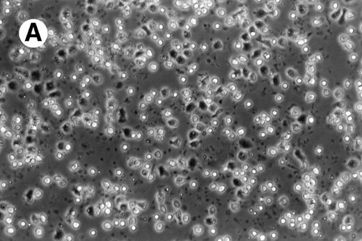 Fig. 1. Morphology of freshly isolated and cultured AML cells. Phase contrast micrographs of freshly isolated AML PBMNC (A; 100× origonal magnification); AML cells cultured for 14 days in GM-CSF, IL-4, and TNF (B; 250× original magnification); or GM-CSF, IL-4, and CD40L (C; 250× origianl magnification). (A and B) Obtained with cells from patient 13; (C) Obtained with cells from patient 18.