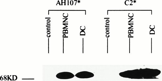 Fig. 4. AML cells cultured in GM-CSF, IL-4, and TNF- express the inv(16) gene product. AML cells from patient 14 were cultured for 14 days in GM-CSF + IL-4 + TNF-. Triton X-100 lysates of freshly isolated and cultured AML cells were separated by sodium dodecyl sulfate-polyacrylamide gel electrophoresis (SDS-PAGE) and then analyzed by Western blotting using antibodies against the N-termini (C2) and C-termini (AH107) of the CBFB-MYH11 inv(16) gene product. Lysates from K562 cell line served as a negative control.