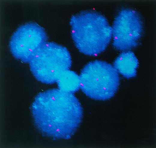 Fig. 3. DC-rich AML cell cultures from a trisomy 8 patient show +8 chromosome in their nuclei. Fluorescein-labeled chromosome 8–specific alpha satellite DNA probe was used to perform FISH analysis on freshly isolated PBMNC or cells cultured for 14 days in GM-CSF + IL-4 + TNF-, or GM-CSF + IL-4 + CD40L. Results depicted were obtained with cells cultured in GM-CSF + IL-4 + TNF-. At least 400 interphase nuclei were examined in each sample to quantitate the percentage of cells with three hybridization signals for chromosome 8. Cells from patient 7 and patient 14 were used for this study. The number of +8 positive cells in the three groups of cells were 93%, 92%, and 88%, respectively. With patient 14, only DC generated with GM-CSF + IL-4 + TNF- were analyzed. Eighty-eight percent of the cells were observed to express trisomy 8.