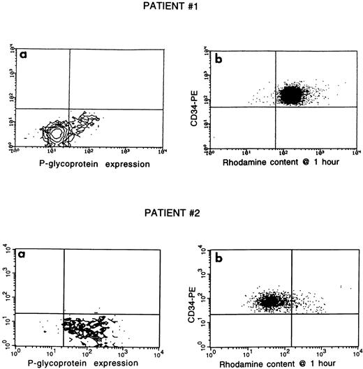 Fig. 1. P-gp expression and the corresponding rhodamine-123 efflux activity. The two left flow cytometer contour plots (a) reflect P-gp expression as measured by staining of blast cells with antibody 4E3.16. Cells in the lower right quadrant are positive for 4E3.16, whereas cells in the left lower quadrant are negative for 4E3.16 because they lack fluorescence above background. The two right flow cytometer cytograms (b) show cellular rhodamine-123 fluorescence after 1 hour of cell incubation at 37°C in CD34-positive blast cells. A shift of rhodamine-123 fluorescence from the right upper to the left upper quadrant reflects cellular efflux of rhodamine-123. Patient #1 showed P-gp expression in a small subpopulation of blast cells and lacked measurable rhodamine-123 efflux activity despite CD34 expression. In patient #2, P-gp was detected on >90% of blast cells and these blast cells showed marked rhodamine-123 efflux activity, which was inhibitable by PSC 833 (data not shown).