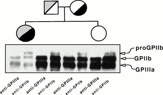 Fig. 2. Immunoprecipitation analysis of platelet GPIIb and GPIIIa from the proband, her mother, father, and sister. Proteins in total platelet lysates were labeled with biotin-NHS, and GPIIb-IIIa complexes were immunoprecipitated using MoAbs specific for GPIIIa (P37) or GPIIb (M3) and processed as described in Materials and Methods.
