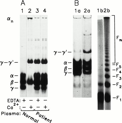Fig. 1. Abnormal fibrin cross-linking profiles in clots obtained from the patient’s plasma in the presence and absence of Ca2+. (A) Normal (lanes 1 and 2) or patient (drawn 7/31/91; lanes 3 and 4) plasma (100 μL) was clotted in the presence of either 1 mmol/L EDTA (lanes 1 and 3) or 10 mmol/L CaCl2(lanes 2 and 4) with 6 U bovine thrombin for 30 minutes at 37°C in a total volume of 500 μL, which also included 40 mmol/L Tris-HCl, pH 7.5, 80 mmol/L NaCl, and 10 U/mL Trasylol. The washed clots were reduced with DTT and analyzed by SDS-PAGE. (B) Normal (lanes 1) or patient (drawn 9/12/91; lanes 2) plasma (100 μL) was clotted in the presence of 1 mmol/L EDTA with 2.5 U bovine thrombin for 30 minutes at 37°C in a total volume of 500 μL, which also included 40 mmol/L Tris-HCl, pH 7.5, 80 mmol/L NaCl, and 10 U/mL Trasylol. The washed clots were dissolved in urea-SDS for electrophoresis on 2% agarose (lanes 1b and 2b) and also, after treatment with DTT, by SDS-PAGE (lanes 1a and 2a). Normal controls were collected from two different donors for the experiments shown in (A) and (B).