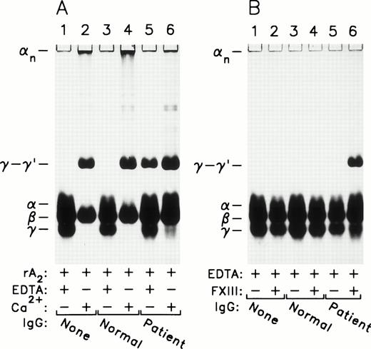 Fig. 2. Effect of the patient’s IgG on the cross-linking of clots obtained in mixtures with purified fibrinogen. (A) Incubations were performed at 37°C for 2 hours in 0.5 mL mixtures containing 50 mmol/L Tris-HCl, pH 7.5, 100 mmol/L NaCl, 0.5 mg/mL human fibrinogen, 2.5 μg/mL rA2, 20 U/mL Trasylol, either no IgG (lanes 1 and 2) or 2 mg/mL normal IgG (lanes 3 and 4) or patient IgG (purified on a ZetaChrom 60 disk from serum drawn on 7/31/91; lanes 5 and 6), either 2 mmol/L EDTA (lanes 1, 3, and 5) or 10 mmol/L CaCl2(lanes 2, 4, and 6), and 12.5 U/mL bovine thrombin. Washed clots were analyzed by SDS-PAGE after reduction with DTT. (B) Incubations were performed at 37°C for 2 hours in 0.5 mL mixtures containing 50 mmol/L Tris-HCl, pH 7.5, 100 mmol/L NaCl, 0.5 mg/mL human fibrinogen, 20 U/mL Trasylol, 2 mmol/L EDTA, either no IgG (lanes 1 and 2) or 2 mg/mL normal IgG (lanes 3 and 4) or patient IgG (lanes 5 and 6), in the absence (lanes 1, 3, and 5) or presence (lanes 2, 4, and 6) of 5 μg/mL human factor XIII (A2B2), and 12.5 U/mL bovine thrombin. Clots were processed and analyzed as in (A).