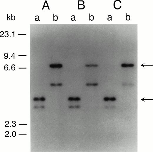 Fig. 2. Southern blot analysis of DNA from original leukemic cells (A), SAS413 (B), and SAS527 (C). DNA was digested withBamHI (a) or BglII (b) and hybridized to a 3′bcr probe. Arrows indicate rearranged bands.