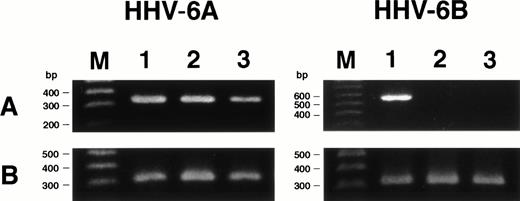 Fig. 7. Expression of HHV-6 mRNA in SAS413 and SAS527. (A) Expression of the HHV-6 immediate-early gene in the cell lines was examined by RT-PCR. cDNA synthesized from cord blood mononuclear cells (lane 1), SAS413 (lane 2), and SAS527 (lane 3) inoculated with HHV-6A or HHV-6B was amplified using primers corresponding to the immediate-early gene. (B) RT-PCR for β-actin gene. Lane M shows marker DNAs.
