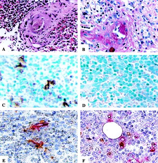 Fig. 1. Photomicrographs of microthrombus, SED, TUNEL staining, and immunohistochemical staining for CD34- and CD68-expressing cells on TUNEL-positive slides. Microthrombus (A) and SED with associated reactive endothelial cells (B) are seen in the splenic section of a representative TTP patient. H&E stain and PAS stain, respectively. TUNEL is positive in the splenic red pulp of a TTP patient (C) and negative in a control patient (D). Methyl green counterstain. Double staining for CD34- or CD68-expressing cells on TUNEL-positive TTP slides demonstrates the presence of apoptotic ECs (E) and apoptotic bodies in the cytoplasm of macrophages (F). Hematoxylin counterstain. Original magnification × 400 for all sections.