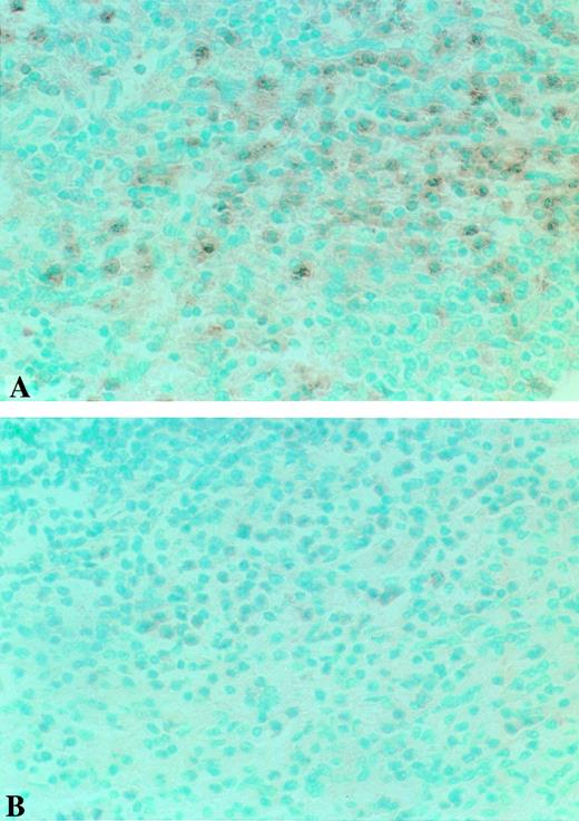 Fig. 2. Photomicrographs of Fas expression in representative TTP and control slides. Fas expression of TTP-8 (A) is enhanced and more intense in appearance than that of Control-6 (B). Original magnifications × 400 for all sections.
