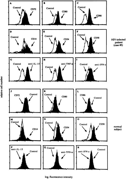 Fig. 3. The flow cytometry profile of AM recovered from a representative HIV-infected patient with lymphocytic alveolitis (case #5) and an uninfected control subject. BAL analysis revealed the presence of a P. carinii pneumonia; 34% of BAL cells were lymphocytes, as determined by morphological evaluation and the CD4/CD8 ratio was 0.03. The profile of CD72, CD80, and CD86 molecules (panels A, B, C, J, K, and L), activation markers (panels D, E, F, M, N, and O), and cytoplasmic cytokines (panels G, H, I, P, Q, and R) was determined as reported in the Materials and Methods section. A consistent pattern of expression of costimulatory molecules and cytoplasmic cytokines was observed in all HIV-infected patients with lymphocytic alveolitis.