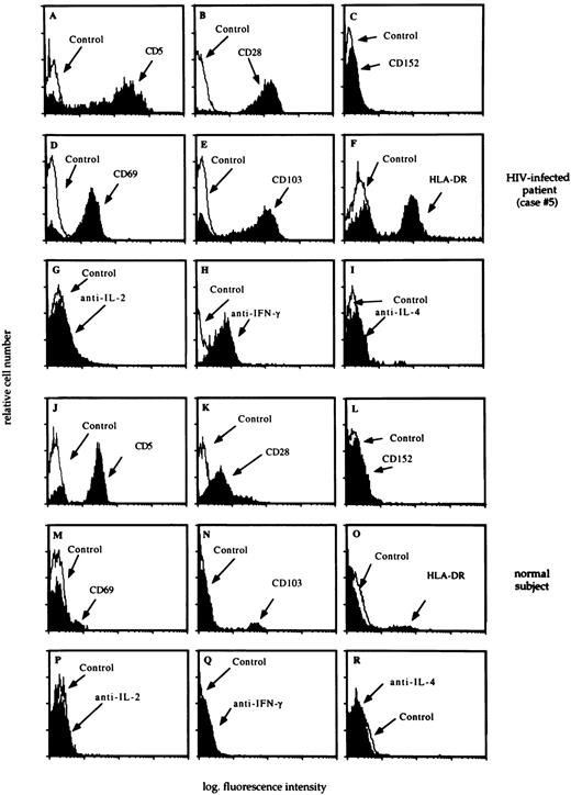 Fig. 4. The flow cytometry profile of BAL T cells recovered from a representative HIV-infected patient with lymphocytic alveolitis (case #5) and an uninfected control subject. Main results of BAL analysis of case #5 are summarized in the legend of Fig 3. The profile of CD5, CD28, and CD152 molecules (panels A, B, C, J, K, and L), activation markers (panels D, E, F, M, N, and O), and cytoplasmic cytokines (panels G, H, I, P, Q, and R) was determined as reported in the Materials and Methods section. A consistent pattern of expression of costimulatory molecules and cytoplasmic cytokines was seen in all HIV-infected patients with lymphocytic alveolitis.