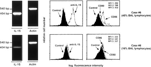 Fig. 5. RT-PCR analysis of the expression of the messages for IL-15 and mean fluorescence intensity values of IL-15, CD80, and CD86 histograms shown by AM recovered from two patients with HIV infection. Specifically, case #6 was a symptomatic patient with AIDS-related complex whereas case #8 had full-blown AIDS (P. cariniipneumonia). The percentages of lymphocytes detected in the BAL are indicated on the right side of the fig. There was a strict association between the expression of IL-15, the MFI of IL-15, and B7 family members and the degree of T-cell infiltration, determined on the basis of BAL lymphocytes percentage. MFI 1: mean fluorescence intensity of control histogram; MFI 2: mean fluorescence intensity of CD80 histogram; MFI 3: mean fluorescence intensity of CD86 histogram.