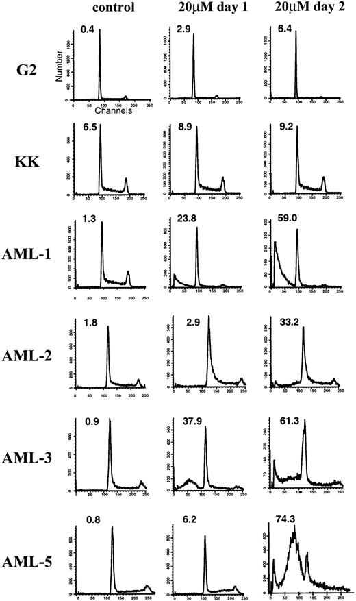 Fig. 3. Representative flow cytometric analysis of ALL (G2 and KK) and AML (AML-1, -2, -3, and -5) cell lines after exposure to lovastatin. The percentage of cells in the pre-G1 (apoptotic) fraction is shown in the upper left quadrant of the individual histograms. Cells were exposed to solvent control (left column), 20 μmol/L lovastatin treatment for 1 day (center column), or 20 μmol/L lovastatin treatment for 2 days (right column).