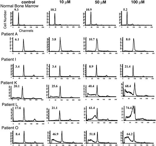 Fig. 6. Flow cytometric analysis of normal bone marrow and AML primary cultures exposed to solvent control or to low (10 μmol/L), intermediate (50 μmol/L), and high (100 μmol/L) concentrations of lovastatin for 2 days. Representative primary cultures from each of the three lovastatin response groups are shown, including a nonresponsive sample A, an intermediate responsive sample I, and sensitive samples K, L, and O. The percentage of cells in the pre-G1 (apoptotic) fraction of the cell cycle is shown in the upper left corner of the individual histograms.
