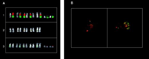 Fig. 5. FISH analysis of the 11q13 breakpoints in MM tumors with a cytogenetically detectable t(11;14)(q13;q32) chromosome translocation. (A) FISH analysis of the KMS12 cell line: (1) partial metaphase cohybridized with chromosome 11 (green) and chromosome 14 (red) painting probes; (2) partial metaphase cohybridized with cosmid I4 (MTC-green) and C1 (red) probes; (3) partial metaphase cohybridized with YAC 961-H-2 (red) and C1 (green) probes. DAPI counterstaining is shown for each chromosome. (B) Double-color interphase FISH analysis of MM tumor AC97. Left: colocalized signals in cohybridization experiments with YAC 744-F-12 (green) and pHS11 (red) probes; right: dissociated signals in cohybridization experiments with pHS11 (red) and cyclin D1 (green) probes. See scheme in Fig 1for the probes used.