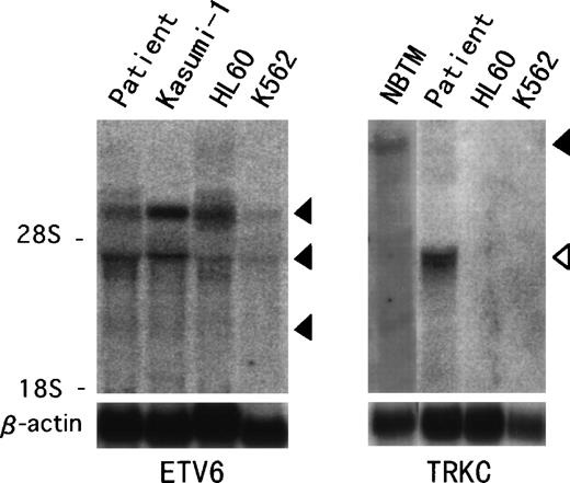 Fig. 4. Northern hybridization of t(12;15) leukemic cells.ETV6 full-length cDNA detects 6.2-, 4.3-, and 2.4-kb transcripts (solid arrowhead) in the t(12;15) leukemic cells and Kasumi-1, HL60, and K562 leukemic cell lines (left panel). TRKCprobe spanning the breakpoint detects a wild-type 14-kb transcript (solid arrowhead) in the NBTM cell line, whereas a 4.3-kb abnormal band (open arrowhead) is detected in the t(12;15) leukemic cells (right panel). No band is detected in HL60 or K562.