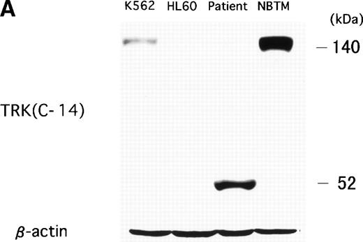 Fig. 6. (A) Abnormal expression of TRKC protein in t(12;15) leukemic cells. Total cell lysates were prepared from NBTM, t(12;15) leukemic cells, HL60 and K562. Wild-type TRK expression is detected in NBTM and weakly in K562. On the other hand, 52-kD abnormal protein is detected only in the t(12;15) leukemic cells. Anti-TRK antibody detects carboxy terminal of the TRK gene family. (B) ETV6/TEL expression in leukemic cells. Western blotting analysis using anti–N-TEL antibody detects a 52-kD band corresponding to the normal ETV6 protein in t(12;15) leukemic cells, HL60, and K562. C-1 ETV6-TRKC protein in t(12;15) leukemic cells is also detected as the 52-kD band. The t(12;15) leukemic cells express a 38-kD protein corresponding to the C-2 and C-3 ETV6-TRKC protein.