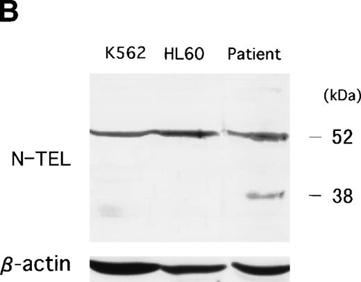 Fig. 6. (A) Abnormal expression of TRKC protein in t(12;15) leukemic cells. Total cell lysates were prepared from NBTM, t(12;15) leukemic cells, HL60 and K562. Wild-type TRK expression is detected in NBTM and weakly in K562. On the other hand, 52-kD abnormal protein is detected only in the t(12;15) leukemic cells. Anti-TRK antibody detects carboxy terminal of the TRK gene family. (B) ETV6/TEL expression in leukemic cells. Western blotting analysis using anti–N-TEL antibody detects a 52-kD band corresponding to the normal ETV6 protein in t(12;15) leukemic cells, HL60, and K562. C-1 ETV6-TRKC protein in t(12;15) leukemic cells is also detected as the 52-kD band. The t(12;15) leukemic cells express a 38-kD protein corresponding to the C-2 and C-3 ETV6-TRKC protein.