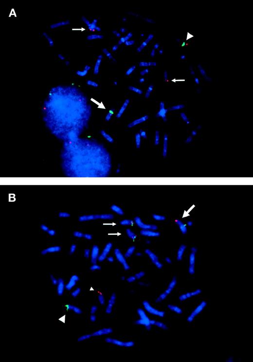 Fig. 2. FISH analysis of ETV6 and TRKC gene rearranged in the metaphase chromosomes. (A) Split signals of cosmid 163E7 (red) are observed on der(12)(q15) and on der(15)(q25). Large arrow indicates der(12), which is identified by chromosome 12 centromeric probe (D12Z3; green). The small arrows indicate der(15). Note that two der(15)s are detected in most metaphases. Large arrowhead indicates normal chromosome 12. (B) 170I1 BAC probe hybridized with 964c10 YAC probe. The 170I1 BAC (red) that encompasses the breakpoint of TRKC shows split signals on der(15)(q25) and on der(12)(p13). 964c10 YAC (green) covering ETV6 locus splits between der(12)(q15) and der(15)(q25), which results in fusion with 170I1 BAC signal on der(15)(q25). Normal chromosome 15 is indicated by a small arrowhead.