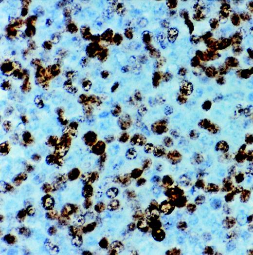 Fig. 2. Immunostaining for proliferation antigen (Ki67) in a sARL showing numerous reactive lymphoma cells (×500).