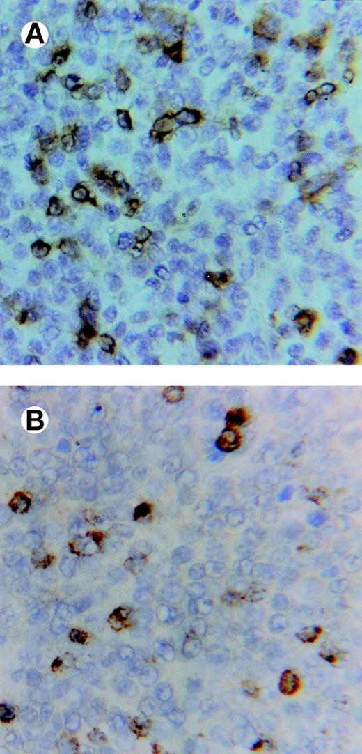 Fig. 4. Immunostaining of a lymphoma showing in (A) abundant, infiltrating CD3+ lymphocytes and in (B) cells expressing the TIA-1 (cytotoxic-related) antigen in an adjacent section (×500).