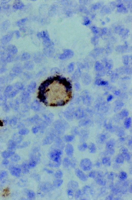 Fig. 5. Immunostaining showing SIVgag p27 expression in a multinucleated giant cell infiltrating a sARL (×500).