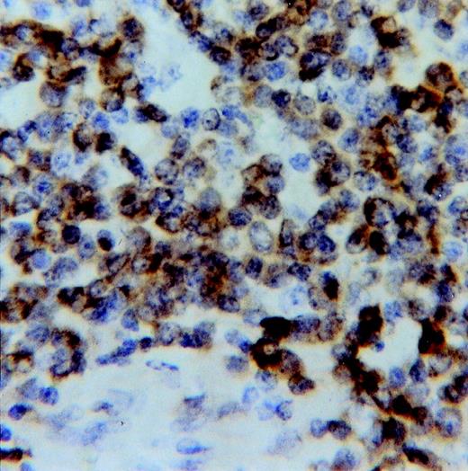 Fig. 6. Immunostaining for Bcl-2. Note the numerous reactive cells (×500).