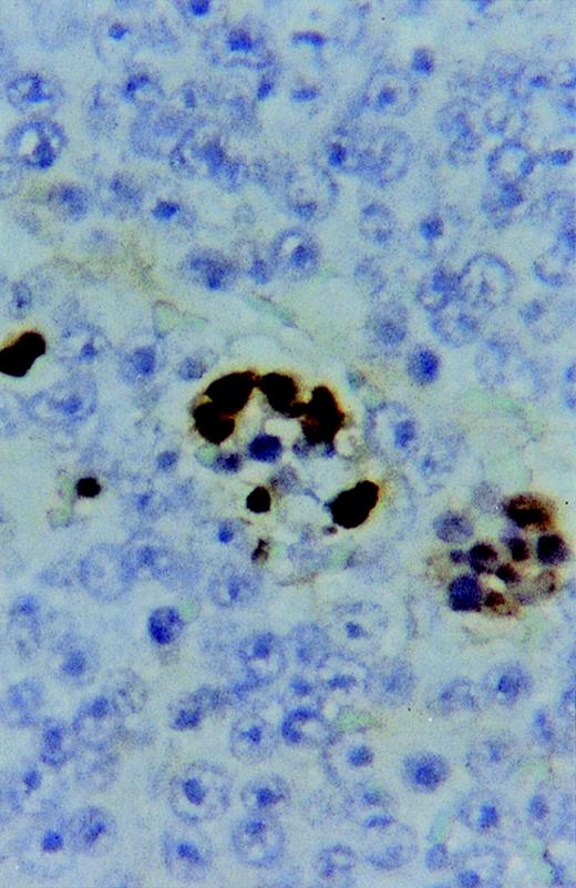 Fig. 7. Apoptotic cells shown by the TUNEL assay in a sARL. Note some apoptotic bodies phagocyted by macrophages (×500).