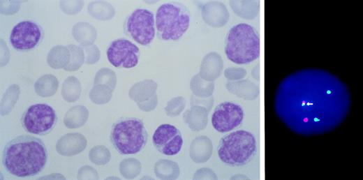 Fig. 1. BCL1 rearranged leukemic MCL with primary BM involvement. Note the heterogeneity of cell size and morphology with irregular nuclear outline (left). A cell showing juxtaposition (arrowed) of BCL1 (green) to IgH (red) sequences is shown on the right.