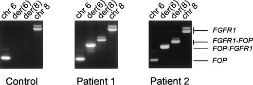 Fig. 5. Expression of the fusion transcripts. RT-PCR were performed using RNAs from the erythroleukemia HEL cell line used as a control (left panel) and from the two t(6;8) patients’ malignant cell samples and specific primers located near the translocation breakpoint. The respective chromosomal positions and the transcripts identified in each reaction are indicated at the top and on the right, respectively.
