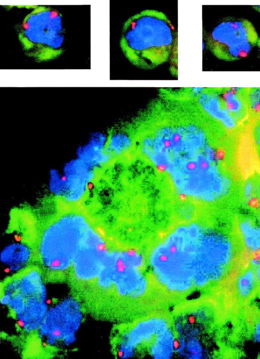 Fig. 3. Cells with multiple or deformed nuclei have multiple copies of some chromosomes. Fluorescence in situ hybridization of log phase cells using probe to centromere no. 7. Blue shows DAPI-stained DNA and red shows centromere no. 7 signal indicating the number of copies of chromosome no. 7. The upper three pictures show examples of LXSN cells that are mononuclear and are diploid, as indicated by two copies each of chromosome 7. The AS21 picture (bottom) shows an example of a single giant cell (center) with 4 nuclear lobular structures. Two of these lobes contain several copies of chromosome 7; therefore, this cell is polyploid.