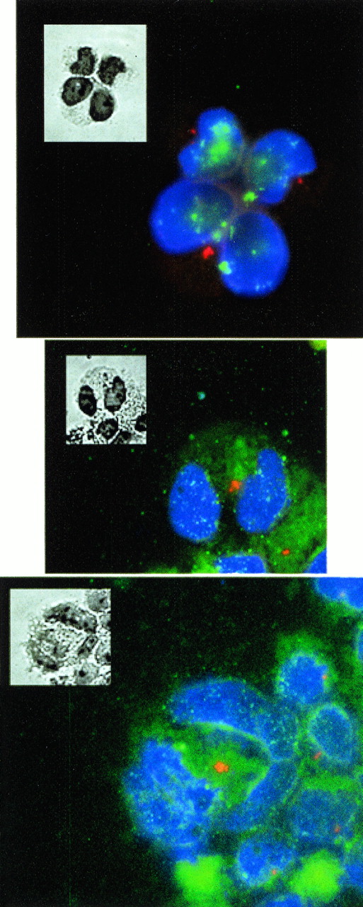 Fig. 11. Effects of antisense p21 mRNA expression on centrosome distribution. These three pictures show examples of cells containing nuclei and stained in situ with antibody to γ-tubulin, which localizes the centrosome (red foci). The nuclei are visualized with DAPI (blue). The insets are phase contrast images of the same cells stained with Giemsa to show the cellular boundries. The upper picture shows three cells. The upper two cells are mononuclear cells and demonstrate a single red centrosomal focus (see text for further descriptions). The lower cell contains a deformed nucleus and demonstrates a cluster of several centrosomal foci. This type of cell was found exclusively in AS21 cultures. The other two pictures show further examples of cells with deformed nuclei also containing several centrosomal foci each.