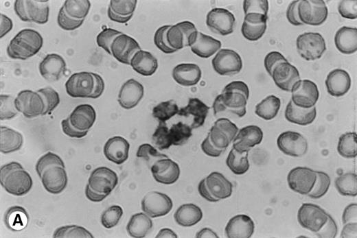 Fig. 7. Immunocytochemical staining of PMN in whole-blood smears. (A) Negative control; no staining was seen with a control Ig. (B) Intracellular fuschia staining was observed in PMN with specific polyclonal anti-OSM antibodies; smears were examined by light microscopy at ×1,200.