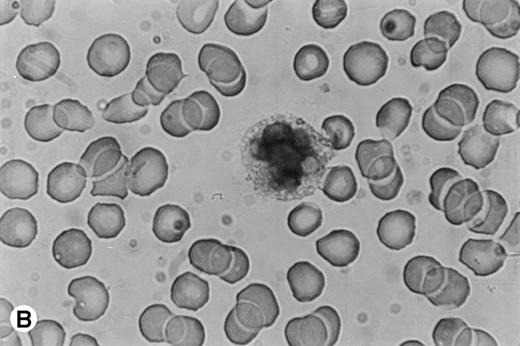 Fig. 7. Immunocytochemical staining of PMN in whole-blood smears. (A) Negative control; no staining was seen with a control Ig. (B) Intracellular fuschia staining was observed in PMN with specific polyclonal anti-OSM antibodies; smears were examined by light microscopy at ×1,200.