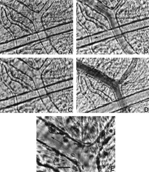 Fig. 3. The inhibitory effect of HDS on SS RBC adhesion in the mesocecum microvasculature. (A) Vessels show clear lumen during perfusion with Ringer-albumin (a, arteriole; v, venule). Bolus infusion of HDS-treated SS RBC results in rapid flow of these cells (B) with no resulting adhesion after the passage of the bolus (C). When untreated SS RBC are infused (D), their passage is accompanied by a variable extent of adhesion in venular segments depicted by small arrows. (E) Higher magnification of the area indicated by small arrows in D shows adhesion of SS RBC. The large arrows indicate the flow direction. Bars = 30 μm.