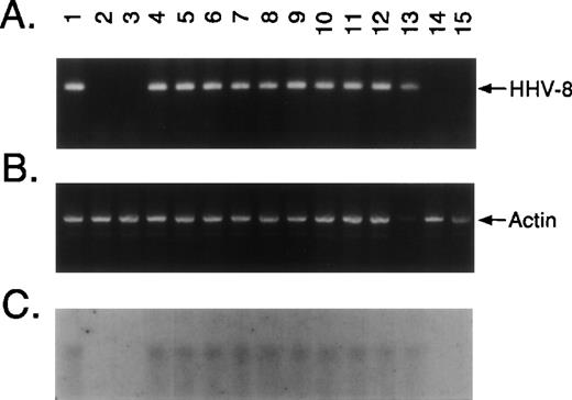 Fig. 1. KSHV DNA sequence (ORF 26) is detectable in MM BMSCs. Ficoll Hypaque BMMCs were freshly obtained from 26 patients with MM and 4 normal donors and cultured for 2 to 6 weeks in Iscove’s media with 10% FBS, 10% horse serum, and penicillin/streptomycin to generate long-term BMSC cultures. Adherent layers were trypsinized and assayed for presence of KSHV DNA sequence. (A) DNA from long-term BMSCs from 12 patients with MM and 2 normal donors were assayed by PCR using primers that amplify KSHV gene sequences (KS330233) followed by nested PCR using primers designed to recognize sequences internal to KS330233 to yield a final PCR product of 186 bp. DNA from BCBL-1 cell line (lane 1) served as a positive control for the detection of KSHV gene sequences and DNA obtained from normal BMSCs (lanes 2 and 3) as a negative control; MM patient BMSCs are shown in lanes 4 through 15. (B) Amplification with β-actin specific primers confirmed DNA in each lane. (C) To confirm the specificty of PCR, nested PCR products were transferred onto nitrocellulose filters. Southern blot analysis was performed by hybridizing the filters with a32P end-labeled 25-bp oligomer probe internal to the KS330233 sequence.