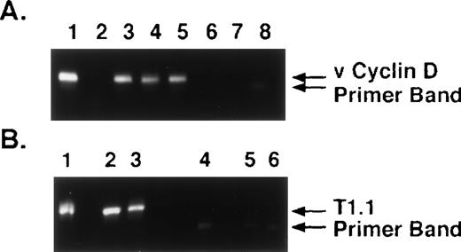 Fig. 2. KSHV DNA sequences viral cyclin D (ORF 72) and T1.1 (ORF K7) are detectable in MM BMSCs. (A) DNA from long-term BMSCs from 4 patients with MM (lanes 2 through 5) and 2 normal donors (lanes 6 and 7) were assayed by nested PCR to amplify viral cyclin D (ORF 72) KSHV gene sequence. DNA from BCBL-1 cell line (lane 1) served as a positive control and water (H2O) (lane 8) served as control for nested PCR contamination. (B) DNA from long-term BMSCS from 2 patients with MM (lanes 2 and 3) and 2 normal donors (lanes 5 and 6) were assayed by nested PCR to amplify T1.1 (ORF K7). DNA from BCBL-1 cell line (lane 1) served as a positive control and water (H2O) (lane 4) served as a control for nested PCR contamination.