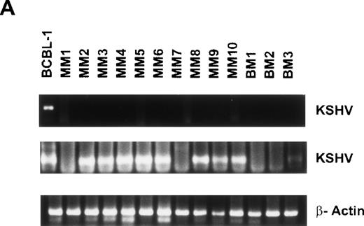 Fig. 4. Detection of KSHV gene sequences in BMDCs and PBDCs from MM patients and normal donors. DNA isolated from BMDCs from 15 MM patients and 6 normal donors was assayed for KSHV gene sequences by PCR using primers that amplify KS330233, followed by a nested PCR using primers internal to this sequence to yield a final PCR product of 186 bp. Results from 10 MM patient BMDCs (lanes 2 through 11) and 3 normal donor BMDCs (lanes 12 through 14) are shown in (A). (B) Results of PCR on PBDCs DNA from 5 MM patients (lanes 2 through 6) and 4 normal donors (lanes 7 through 10). In each case DNA from BCBL-1 cell line (lane 1) served as the positive control. β-Actin was amplified in all samples to ensure adequacy and integrity of DNA.