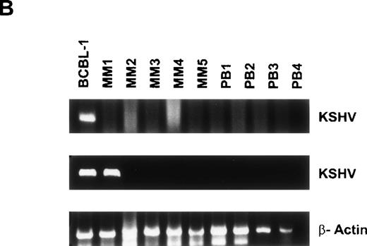 Fig. 4. Detection of KSHV gene sequences in BMDCs and PBDCs from MM patients and normal donors. DNA isolated from BMDCs from 15 MM patients and 6 normal donors was assayed for KSHV gene sequences by PCR using primers that amplify KS330233, followed by a nested PCR using primers internal to this sequence to yield a final PCR product of 186 bp. Results from 10 MM patient BMDCs (lanes 2 through 11) and 3 normal donor BMDCs (lanes 12 through 14) are shown in (A). (B) Results of PCR on PBDCs DNA from 5 MM patients (lanes 2 through 6) and 4 normal donors (lanes 7 through 10). In each case DNA from BCBL-1 cell line (lane 1) served as the positive control. β-Actin was amplified in all samples to ensure adequacy and integrity of DNA.
