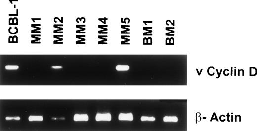 Fig. 5. Detection of ORF 72 (viral cyclin D) gene sequences in BMDCs from MM patients. DNA isolated from 5 MM BM DCs were assayed for ORF 72 gene sequences. BCBL-1 served as the positive control (lane 1) and lanes 2 through 6 represent MM patient samples. Lanes 7 and 8 are normal BMDC controls.