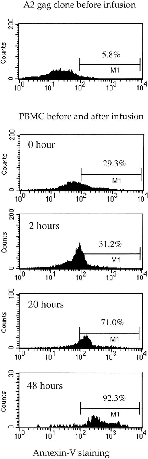 Fig. 3. Death of tetramer-specific A2 Gag cells in vivo before and after infusion. The A2 Gag clone (before infusion) and PBMC obtained from the patient at the time-points indicated were stained with anti–CD8-tricolor, Gag-specific tetramer-PE, and Annexin-V-FITC. The histograms represent Annexin V staining of the CD8+/tetramer-positive cells.