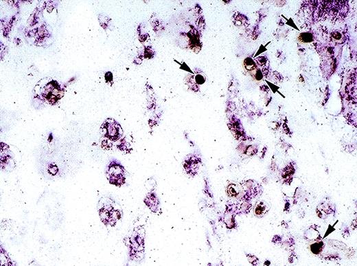 Fig. 3. Cell identification and localization by double staining for asialo GM1 and von Willebrand factor. Immunohistochemical analysis of a paraffin-embedded section from a Matrigel plug stimulated with bFGF + IL-12 using mouse monoclonal antibody to asialo GM1 and a rabbit anti–von Willebrand factor antiserum. Asialo GM1-positive cells (dark brown) are indicated by arrows; von Willebrand factor positive cells are purple. Original magnification ×40.