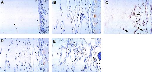 Fig. 6. Immunohistochemical detection of murine IP-10 in Matrigel plugs from C57BL/6 mice treated with or without anti–NK 1.1 monoclonal antibody treatment. Paraffin-embedded sections from Matrigel plugs alone (A); plugs impregnated with bFGF (B); plugs impregnated with bFGF + IL-12 (C); plugs impregnated with bFGF + monoclonal anti–NK 1.1 antibody (D); and plugs impregnated with bFGF + IL-12 + monoclonal anti–NK 1.1 antibody (E) were stained with a rabbit antimouse IP-10 antiserum and counterstained with hematoxylin. Some IP-10–positive cells (brown) are indicated by arrows. Original magnification ×40.