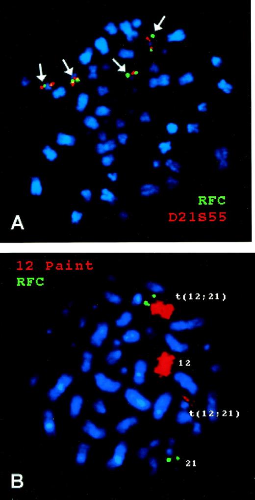 Fig. 3. FISH of a human RFC probe with chromosomes from B-lineage ALL blasts. (A) is from a hyperdiploid ALL blast with 4 copies of chromosome 21. The green signal is from the RFC gene probe and the red signal from a chromosome 21q22.3-ter probe. (B) is from a nonhyperdiploid ALL blast with 2 copies of chromosome 21, one of which is involved in a 12;21 translocation. The green signal is from the RFC gene probe and the red signal is from a chromosome 12 probe (Coatasome 12).