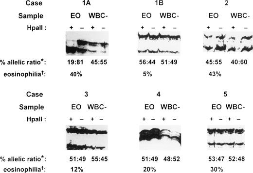 Fig. 4. HUMARA analysis of patients with eosinophilia. Case 1, idiopathic hypereosinophilic syndrome; case 2, Churg-Strauss syndrome; case 3, eosinophilia secondary to phenytoin ingestion; case 4, eosinophilia secondary to Strongyloidiasis infection; and case 5, eosinophilia secondary to house dustmite allergy causing atopic eczema. Case 1A, sample obtained at initial presentation; case 1B, sample obtained 26 months after initial presentation; EO, purified eosinophil fraction; WBC–, eosinophil-depleted leukocyte fraction; +, DNA amplified after HpaII precutting; –, DNA amplified without HpaII precutting; *, percent allelic ratio: this is the ratio of the band intensity of the upper allele to the lower allele after HpaII digestion as a percentage of the total intensity of the two alleles. The intensity of each band after HpaII digestion was first corrected by dividing it by the signal obtained for that allele in the undigested sample (for details, see Materials and Methods). †, eosinophilia: percentage eosinophils of the peripheral blood total white cell count before eosinophil purification.