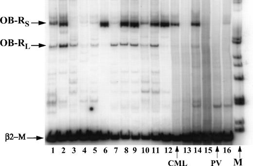 Fig. 3. Expression of long and short isoforms of OB-R by RT-PCR in AML (N 2,3,5-9,11,13, 15,16) and MDS (N 1,4,10,12,14) samples. PV, polycytemia vera.