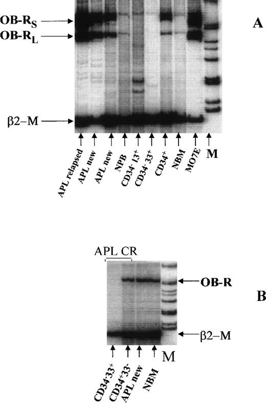 Fig. 5. (A) Expression of both isoforms of OB-R in two patients newly diagnosed with APL and one patient with recurrent APL compared with expression in normal bone marrow (NBM), FACS-sorted normal myeloid progenitors, peripheral blood (PB), and MO7E cells (as positive control). In one APL sample (lane 3) OB-R expression was detected in peripheral blood containing 37% promyelocytes. (B) OB-R expression of FACS-sorted CD34+33− and CD34−33+ APL cells in complete remission (CR). OB-R was identified only in the CD34+compartment of NBM. In contrast, in a sample from a patient with newly diagnosed APL containing 90% promyelocytes and no CD34+cells, the level of OB-R expression corresponded to that seen in NBM, which was used as a control.