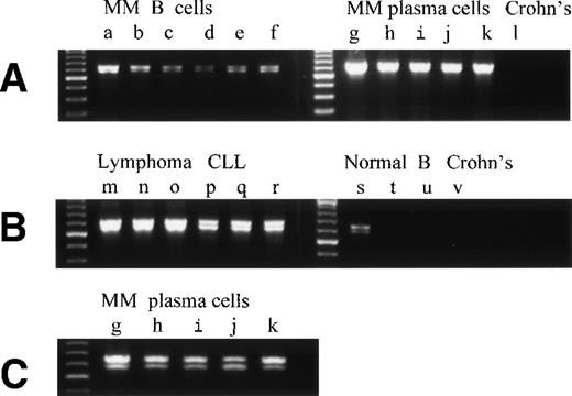 Fig. 6. Overexpression of RHAMMFL and RHAMM−48 from MM B and plasma cells, B-lymphoma, and B-CLL, as compared with normal B cells and chronically activated B cells from patients with Crohn’s disease. (A) RHAMMFL and RHAMM−48 were amplified by RT-PCR from 500 ng of RNA from the B cells of 6 myeloma patients (a, b, c, d, e, f), the BM plasma cells of 5 myeloma patients (g, h, I, j, k), and the pooled B cells from 2 patients with Crohn’s disease (lane l). The same quantity of RNA (500 ng) and cDNA (5 μL) was used in the RT-PCR step for all cell populations analyzed so that the level of RHAMM expression could be compared between the different cell populations in the figure. The quality of RNA isolated from all B-cell populations was comparable as determined by amplification of CD19 transcripts from a separate aliquot of the same cDNA (5 μL) from which RHAMM was amplified (data not shown). A 613-bp fragment was amplified for RHAMMFL and a 565-bp fragment for RHAMM−48. (B) RHAMMFL and RHAMM−48 were amplified by RT-PCR from 500 ng of RNA from the malignant lymph nodes of 3 patients (m, n, o), the PBMC of 3 CLL patients (p, q, r), the B cells of 3 normal individuals (s, t, u), and the B cells from a patient with Crohn’s disease (v). The same quantity of RNA (500 ng) and cDNA (5 μL) was used in the RT-PCR step for all cell populations analyzed so that the level of RHAMM expression could be compared between the different cell populations in the figure. The quality of RNA isolated from all B-cell populations was comparable as determined by amplification of CD19 transcripts from a separate aliquot of the same cDNA (5 μL) from which RHAMM was amplified (data not shown). (C) Shows that the amplification product in A, from the BM plasma cells of patients g, h, I, j, and k, resolves into RHAMMFL and RHAMM−48. The amplification products were analyzed by gel electrophoresis and visualized by ethidium bromide staining.