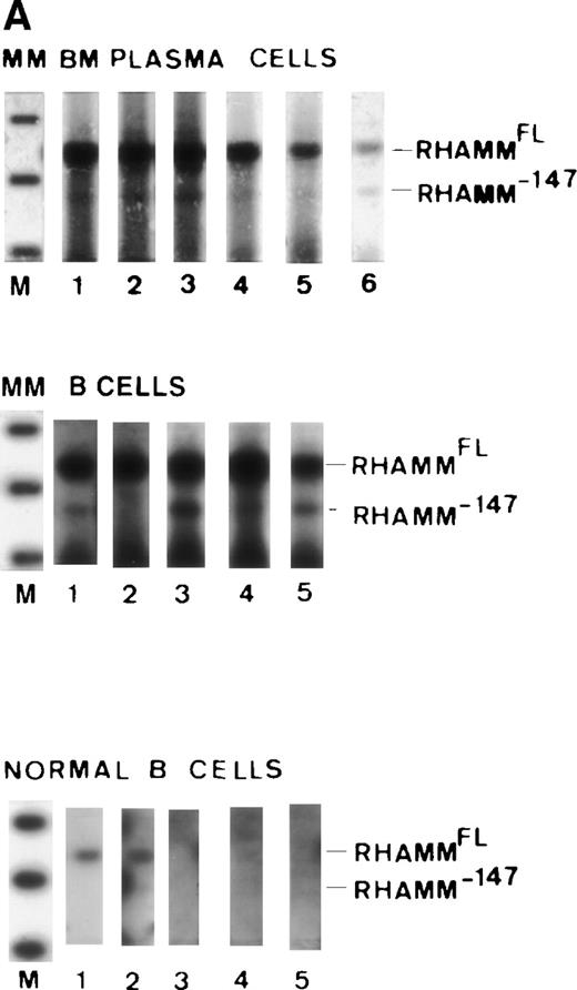 Fig. 7. Overexpression of RHAMMFL and RHAMM−147 in MM, B-lymphoma, and B-CLL, as compared with normal B cells and chronically activated B cells from patients with Crohn’s disease. (A) RHAMMFL and RHAMM−147 were amplified by RT-PCR of 1μg RNA from the BM plasma cells of 6 myeloma patients, from the B cells of 5 myeloma patients, and from the B cells of 5 normal individuals. The same quantity of RNA (1 μg) and cDNA (5 μL) was used in the RT-PCR step for all cell populations analyzed so that the level of RHAMM expression could be compared between the different cell populations in the figure. The quality of RNA isolated from all cell populations was comparable as determined by amplification of histone transcripts from a separate aliquot of the same cDNA (1 μL) from which RHAMM was amplified (data not shown). Markers are 1,114, 900, and 692 bp. A 989-bp fragment was amplified for RHAMMFL and a 842-bp fragment for RHAMM−147. The amplification products were transferred to a nylon membrane and hybridized to a DIG-labeled RHAMM probe. BM plasma cell RHAMM was visualized by colorimetric detection; color development was for 1 hour. MM B-cell RHAMM and normal B cell RHAMM was detected by chemiluminescence; exposure was for 18 hours. (B) RHAMMFLand RHAMM−147 were amplified by RT-PCR of 500 ng RNA from the malignant lymph nodes of 3 patients (m, n, o), the PBMC of 3 CLL patients (p, q, r), the B cells of 3 normal individuals (s, t, u), and the B cells from a patient with Crohn’s disease (v). The same quantity of RNA (500 ng) and cDNA (5 μL) was used in the RT-PCR step for all cell populations analyzed so that the level of RHAMM expression could be compared between the different cell populations in the figure. The quality of RNA isolated from all B-cell populations was comparable as determined by amplification of CD19 transcripts from a separate aliquot of the same cDNA (5 μL) from which RHAMM was amplified (data not shown). A 989-bp fragment was amplified for RHAMMFL and a 842-bp fragment for RHAMM−147; arrows indicate their position. The amplification products were transferred to a nylon membrane and hybridized to a DIG-labeled RHAMM probe. RHAMM was visualized by colorimetric detection; color development was for 1 hour. Markers are 1,114 and 900 bp.