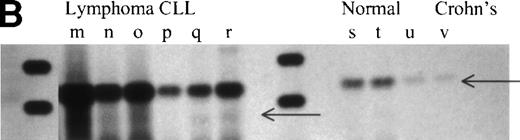 Fig. 7. Overexpression of RHAMMFL and RHAMM−147 in MM, B-lymphoma, and B-CLL, as compared with normal B cells and chronically activated B cells from patients with Crohn’s disease. (A) RHAMMFL and RHAMM−147 were amplified by RT-PCR of 1μg RNA from the BM plasma cells of 6 myeloma patients, from the B cells of 5 myeloma patients, and from the B cells of 5 normal individuals. The same quantity of RNA (1 μg) and cDNA (5 μL) was used in the RT-PCR step for all cell populations analyzed so that the level of RHAMM expression could be compared between the different cell populations in the figure. The quality of RNA isolated from all cell populations was comparable as determined by amplification of histone transcripts from a separate aliquot of the same cDNA (1 μL) from which RHAMM was amplified (data not shown). Markers are 1,114, 900, and 692 bp. A 989-bp fragment was amplified for RHAMMFL and a 842-bp fragment for RHAMM−147. The amplification products were transferred to a nylon membrane and hybridized to a DIG-labeled RHAMM probe. BM plasma cell RHAMM was visualized by colorimetric detection; color development was for 1 hour. MM B-cell RHAMM and normal B cell RHAMM was detected by chemiluminescence; exposure was for 18 hours. (B) RHAMMFLand RHAMM−147 were amplified by RT-PCR of 500 ng RNA from the malignant lymph nodes of 3 patients (m, n, o), the PBMC of 3 CLL patients (p, q, r), the B cells of 3 normal individuals (s, t, u), and the B cells from a patient with Crohn’s disease (v). The same quantity of RNA (500 ng) and cDNA (5 μL) was used in the RT-PCR step for all cell populations analyzed so that the level of RHAMM expression could be compared between the different cell populations in the figure. The quality of RNA isolated from all B-cell populations was comparable as determined by amplification of CD19 transcripts from a separate aliquot of the same cDNA (5 μL) from which RHAMM was amplified (data not shown). A 989-bp fragment was amplified for RHAMMFL and a 842-bp fragment for RHAMM−147; arrows indicate their position. The amplification products were transferred to a nylon membrane and hybridized to a DIG-labeled RHAMM probe. RHAMM was visualized by colorimetric detection; color development was for 1 hour. Markers are 1,114 and 900 bp.