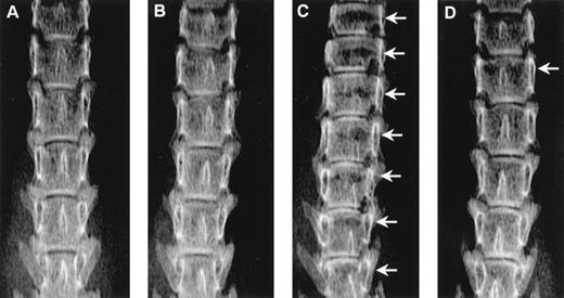 Fig. 2. Radiographs showing the effect of ibandronate (4 μg per mouse per day for 28 days) on osteolytic lesions (arrows) in the lumbar vertebrae of 5TGM1 myeloma-bearing mice. (A) Non–tumor-bearing control treated with PBS. (B) Non–tumor-bearing control treated with ibandronate. (C) 5TGM1 myeloma-bearing mouse treated with PBS. (D) 5TGM1 myeloma-bearing mouse treated with ibandronate. Note the large number of lesions visible in myeloma-bearing mice treated with PBS (C), which are prevented by treatment with ibandronate (D). Note also the reduction in height of the lumbar vertebrae in myeloma-bearing mice treated with PBS (C) as compared with controls (A), (B), and myeloma-bearing mice treated with ibandronate (D). There are seven vertebrae visible in the field in (C), as compared with six in (A), (B), and (D).